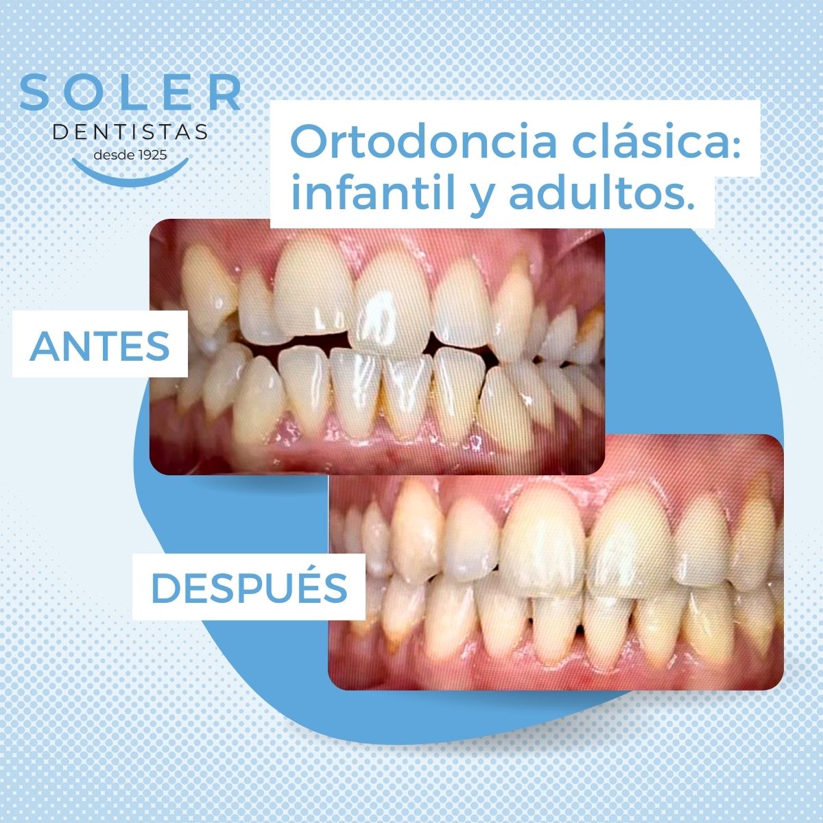 Ortodoncia caso de éxito