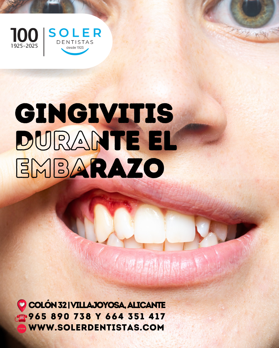 Soler_Embarazo_Gingivitis